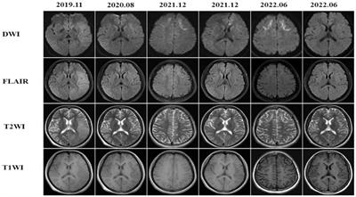 Longitudinal course of hyperintensity on diffusion weighted imaging in adult-onset neuronal intranuclear inclusion disease patients